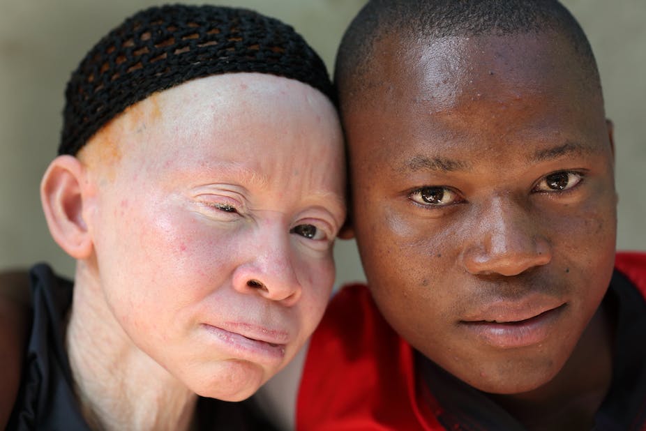 Watch “Albinos in Tanzania: ‘killed like animals'” on&nbsp;YouTube