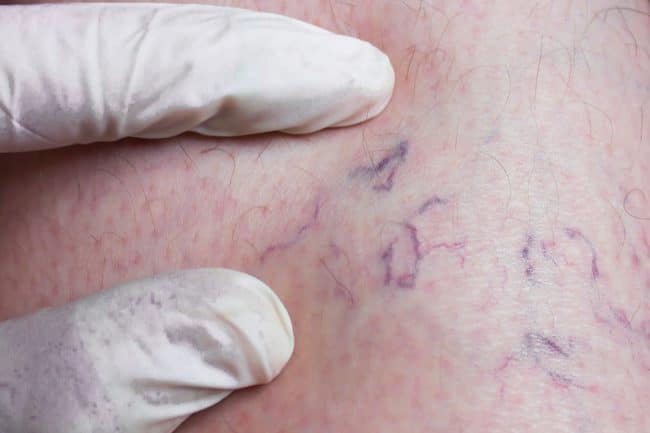 Watch “My Varicose Veins Story 6 month update (post phlebectomy, ablation, sclerotherapy, and Varithena)” on&nbsp;YouTube