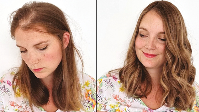 Watch “Androgenetic Alopecia: My nightmare, My solution” on&nbsp;YouTube