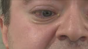 Watch “USC-developed retinal implant gives new vision to blind patient” on&nbsp;YouTube