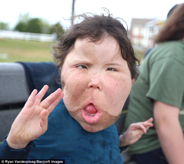 Watch “Katie’s Life with an Enlarged Brain” on&nbsp;YouTube